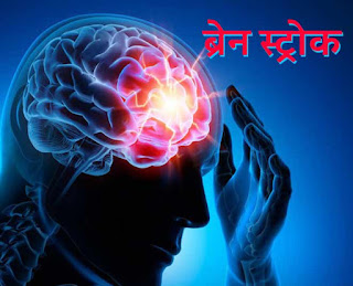 brain-stroke symptoms and causes