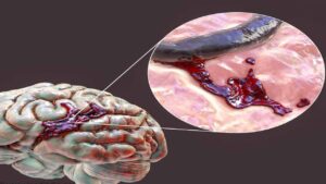 Brain Bleed/Hemorrhage : Intracranial Hemorrhage