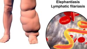 Lymphatic filariasis (Elephantiasis) : Symptoms, Causes and current Treatment for filariasis