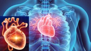 What is Cardiovascular disease? - Symptoms, Causes