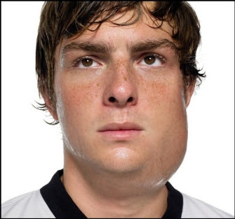 Mumps Symptoms Causes and Treatment