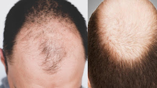 Baldness symptoms and causes