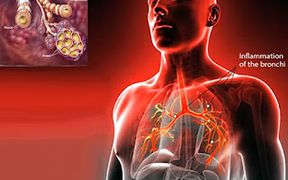 Bronchitis symptoms and causes