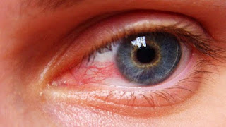 Black cataract symptoms and causes