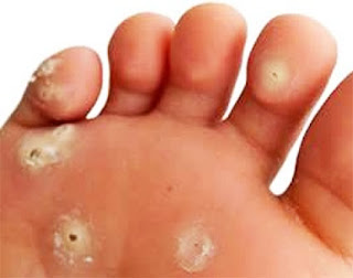 Foot Corn symptoms and causes