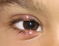 Stye symptoms causes and Treatment