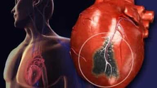 heart enlargement Stymptoms and causes