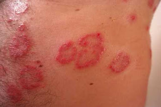 ringworm symptoms causes and types