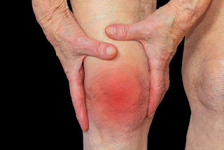 Arthritis symptoms and causes