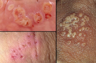 Herpes Symptoms and Causes