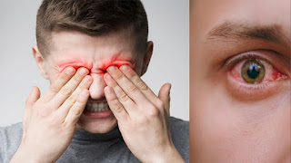 eye inflammation symptoms causes and Prevention