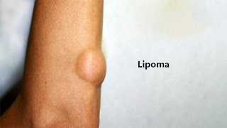 Lipoma Symptoms and Causes